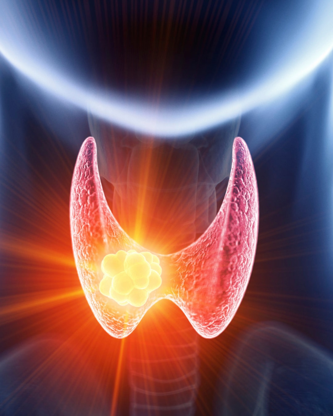 Tiroid Kanseri - Prof. Dr. Serdar Tezelman